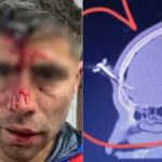 Le clavaron una llave en la cabeza a un jugador del Ascenso durante una salvaje pelea en un torneo de fútbol femenino